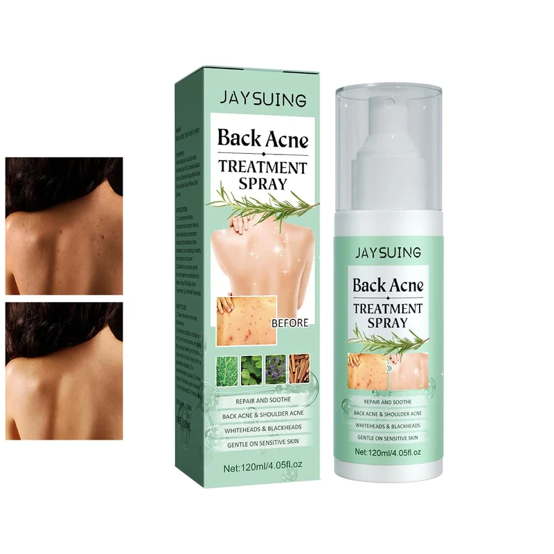 JAYSUING Back Acne Treatment Spray (120ml / 4.05 fl.oz)