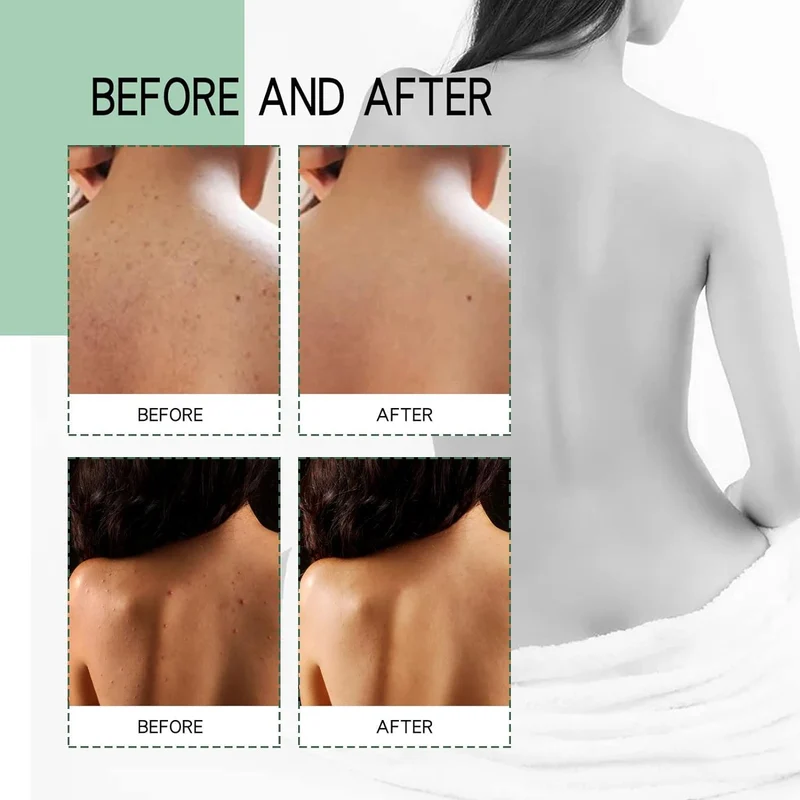 JAYSUING Back Acne Treatment Spray (120ml / 4.05 fl.oz)