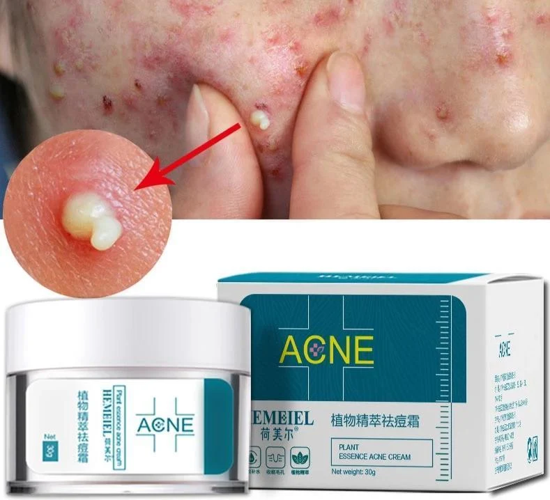 HEMEIEL Plant Essence Acne Cream – 30g