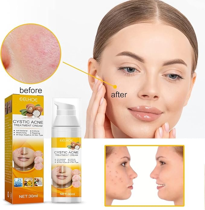 EELHOE Cystic Acne Treatment Cream (30ml)