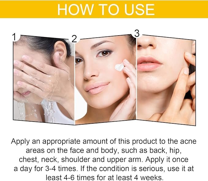 EELHOE Cystic Acne Treatment Cream (30ml)