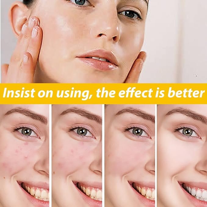 EELHOE Cystic Acne Treatment Cream (30ml)