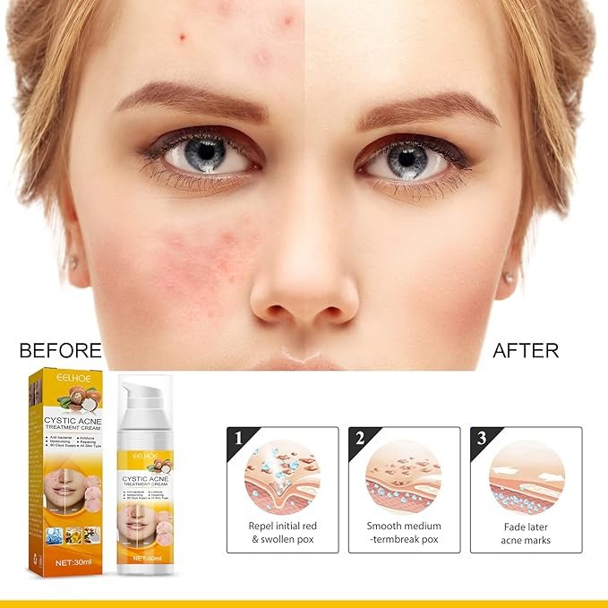 EELHOE Cystic Acne Treatment Cream (30ml)