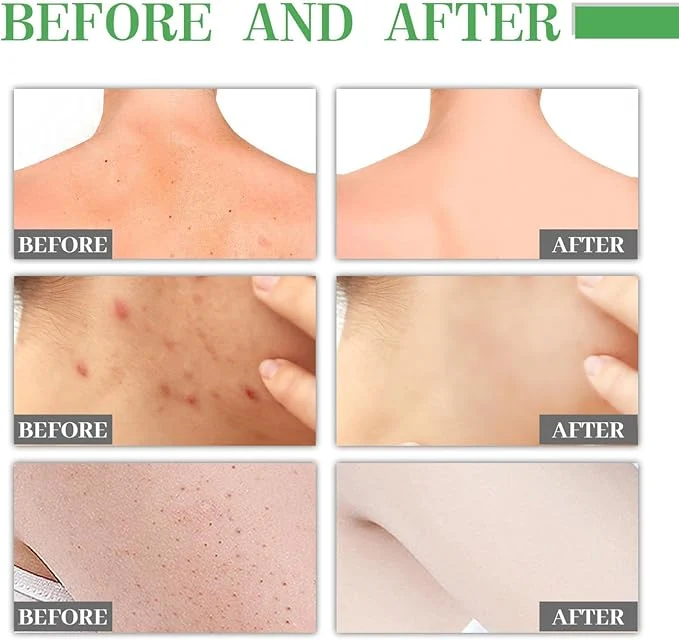 Jaysuing Body Acne Removing Essence (30ml)