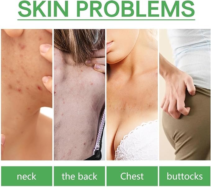 Jaysuing Body Acne Removing Essence (30ml)