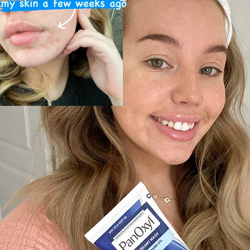PanOxyl Acne Treatment Set – 4% Benzoyl Peroxide Creamy Wash (6 oz / 170 g) & PM Overnight Spot Patches (40 Count)