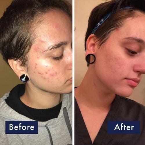 PanOxyl Acne Foaming Wash – 10% Benzoyl Peroxide Maximum Strength (5.5 oz / 156 g)